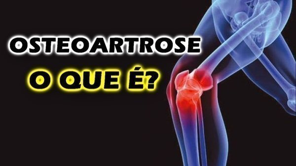 Osteoartrose o que é Quais os sintomas Buscar Saúde