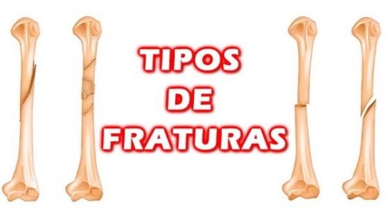 Fratura Exposta O Que Tipos De Fraturas Buscar Sa De