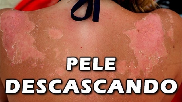 P Descascando Como Tratar A Pele Descascando Buscar Sa De