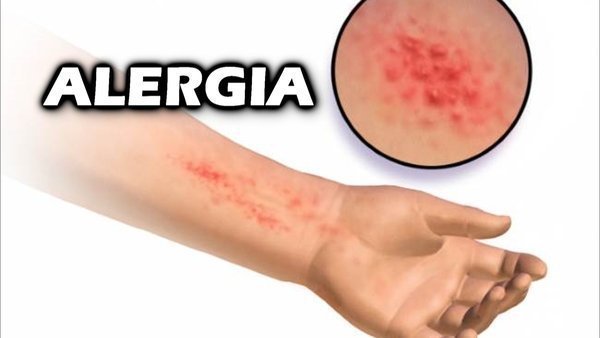 Alergia Na Pele, O Que Pode Ser? Como Tratar? - Buscar Saúde