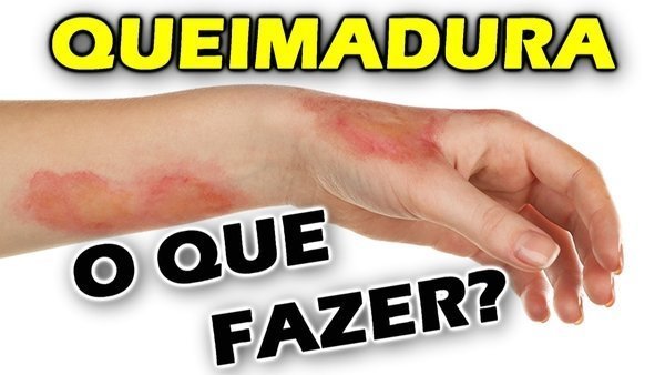 Queimadura Na Pele O Que Fazer E O Que Passar Buscar Sa De