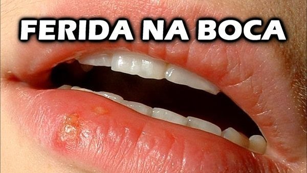 Ferida na boca, o que pode ser? - Buscar Saúde