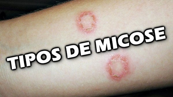 Micose, Quais Os Tipos E Como Tratar? - Buscar Saúde